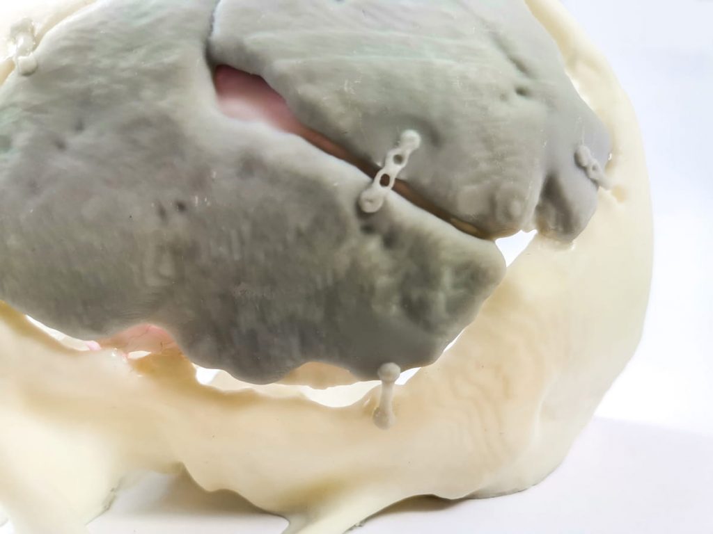 Cirugía cerebral realizada con éxito con el uso de biomodelos 3D