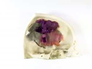 Cirugía cerebral realizada mediante el uso de biomodelos 3D