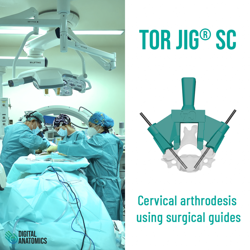artrodesis cervical usando las guías de Digital Anatomics