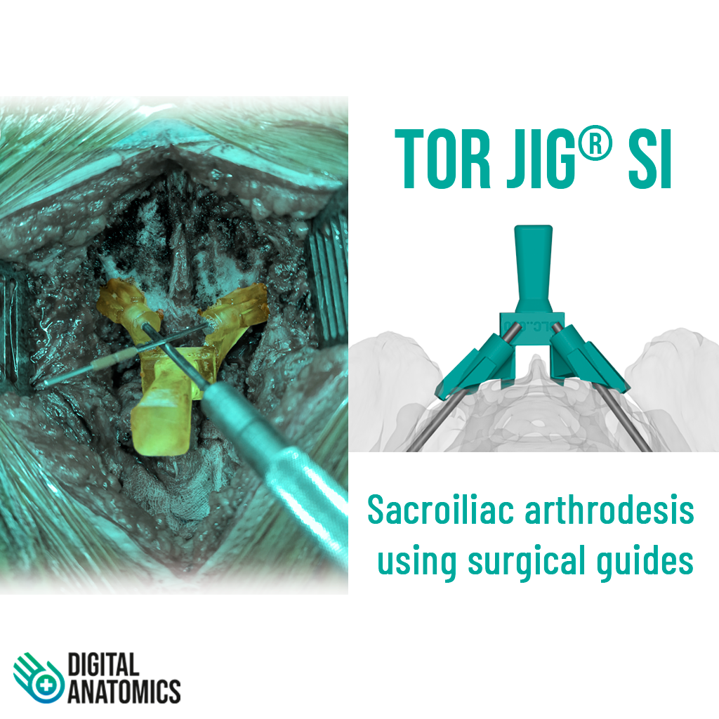 Artrodesis sacroiliaca usando las guías quirúrgicas