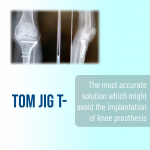 La solución más precisa que puede llegar a evitar la implantación de prótesis de rodilla