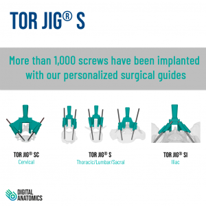 More than 1,000 screws have been implanted with our personalized surgical guides